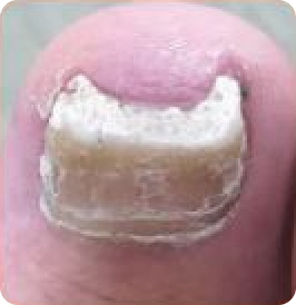 Distal Subungual Onychomycosis