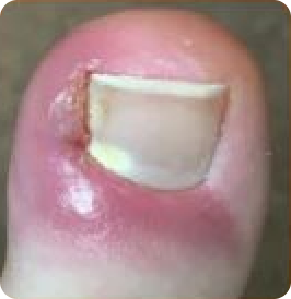 Ingrown Toenail