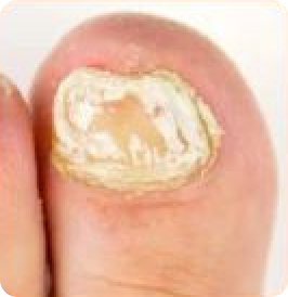 White Superficial Onychomycosis