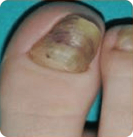Hypertrophy of the Nail Plate