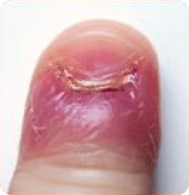 Paronychia